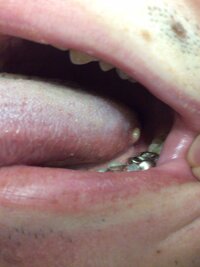 画像有舌の横奥に白い出来物があることに気付きました 3 4ミリ Yahoo 知恵袋
