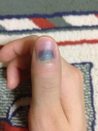 指を挟んで 爪が変色 腫れ有 何科に行くべきでしょうか 昨日 扉に指を挟 Yahoo 知恵袋