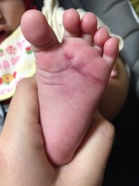 生後9ヶ月の赤ちゃんの足裏に赤い内出血のようなものが出来てました以前もぽつぽつ Yahoo 知恵袋