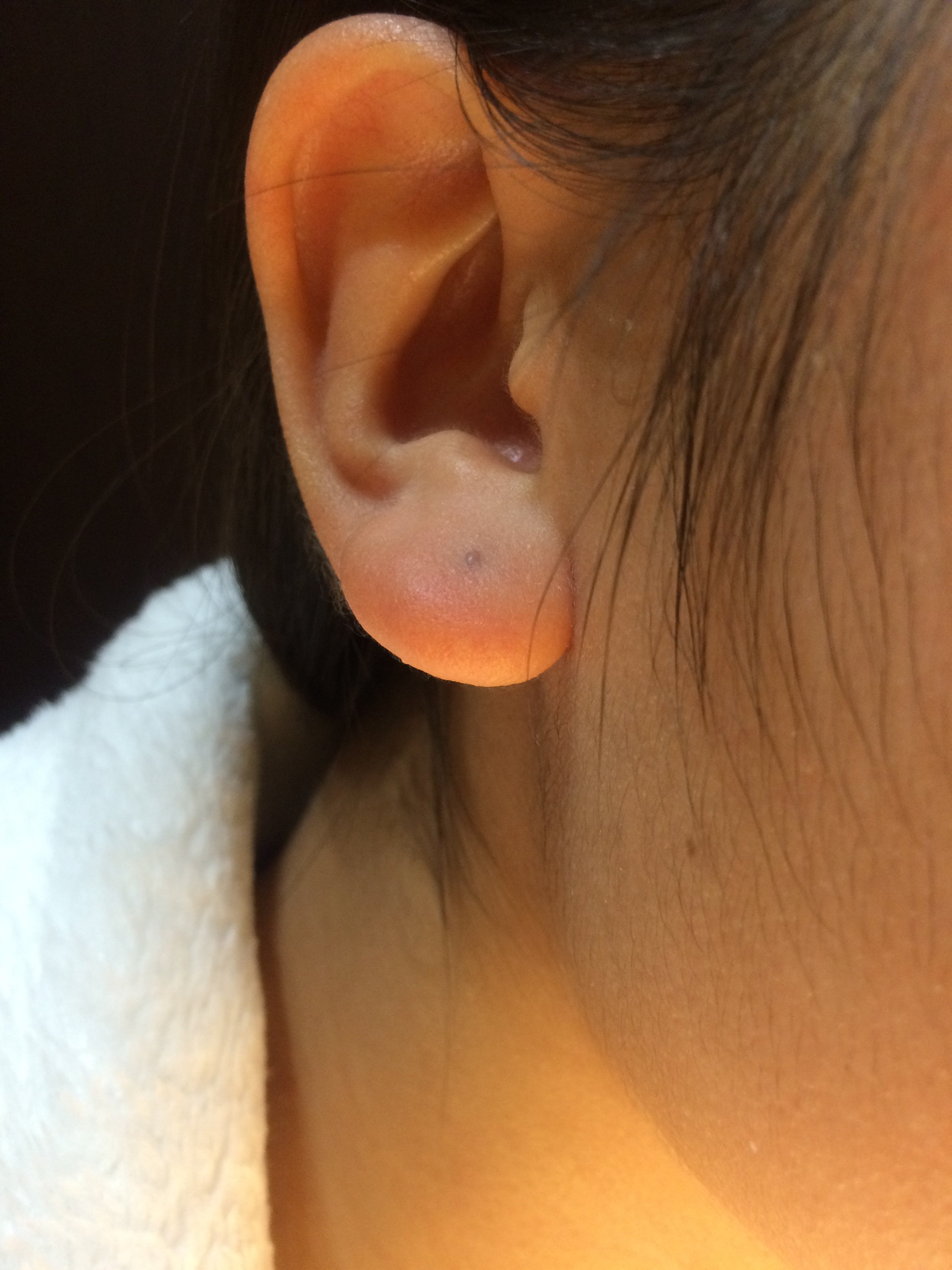 ピアス 塞がっ た