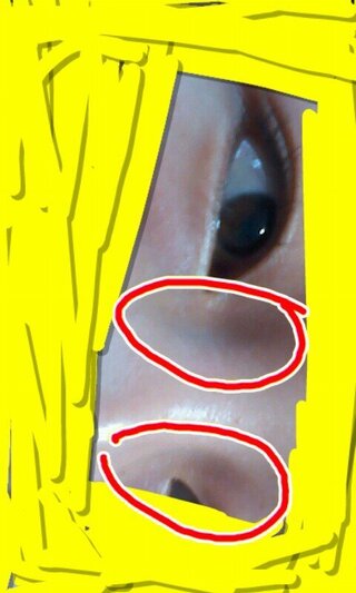 Yahoo!知恵袋【画像あり】この目と鼻の間の黒ずみ?はどうやったら治りますか?