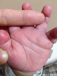 赤ちゃんのしもやけ 乾燥 水虫 始めは赤ちゃんの手の指の間や手のひらや指 Yahoo 知恵袋