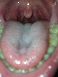 玉 におい 喉の奥から出てくる白い塊、におい玉の対処法