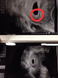 胎嚢見えるが胎芽が見えない 8週1日2人目妊娠中です いつもお世話になっ Yahoo 知恵袋