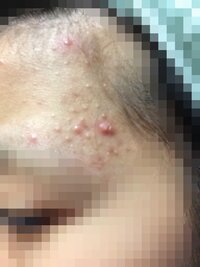 こめかみのニキビが全然治りません 直す方法を知ってる方いらっしゃいま Yahoo 知恵袋