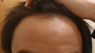 生え際がこんな感じの高校生です 生え際はもとから薄いです 今育毛剤のチャップア Yahoo 知恵袋