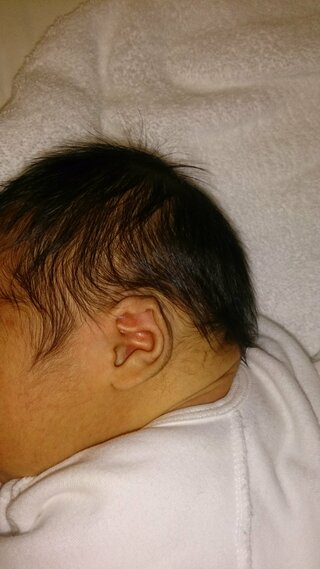ダウン症 新生児 特徴 耳 1000 食品の写真 最高