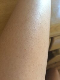 脚のムダ毛が生える根元が膨らんで ぶつぶつしています ツルツルの脚にする Yahoo 知恵袋