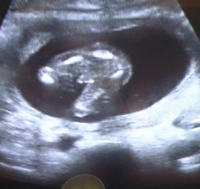 16週のエコーなのですが これって男か女かどっちだと思い Yahoo 知恵袋