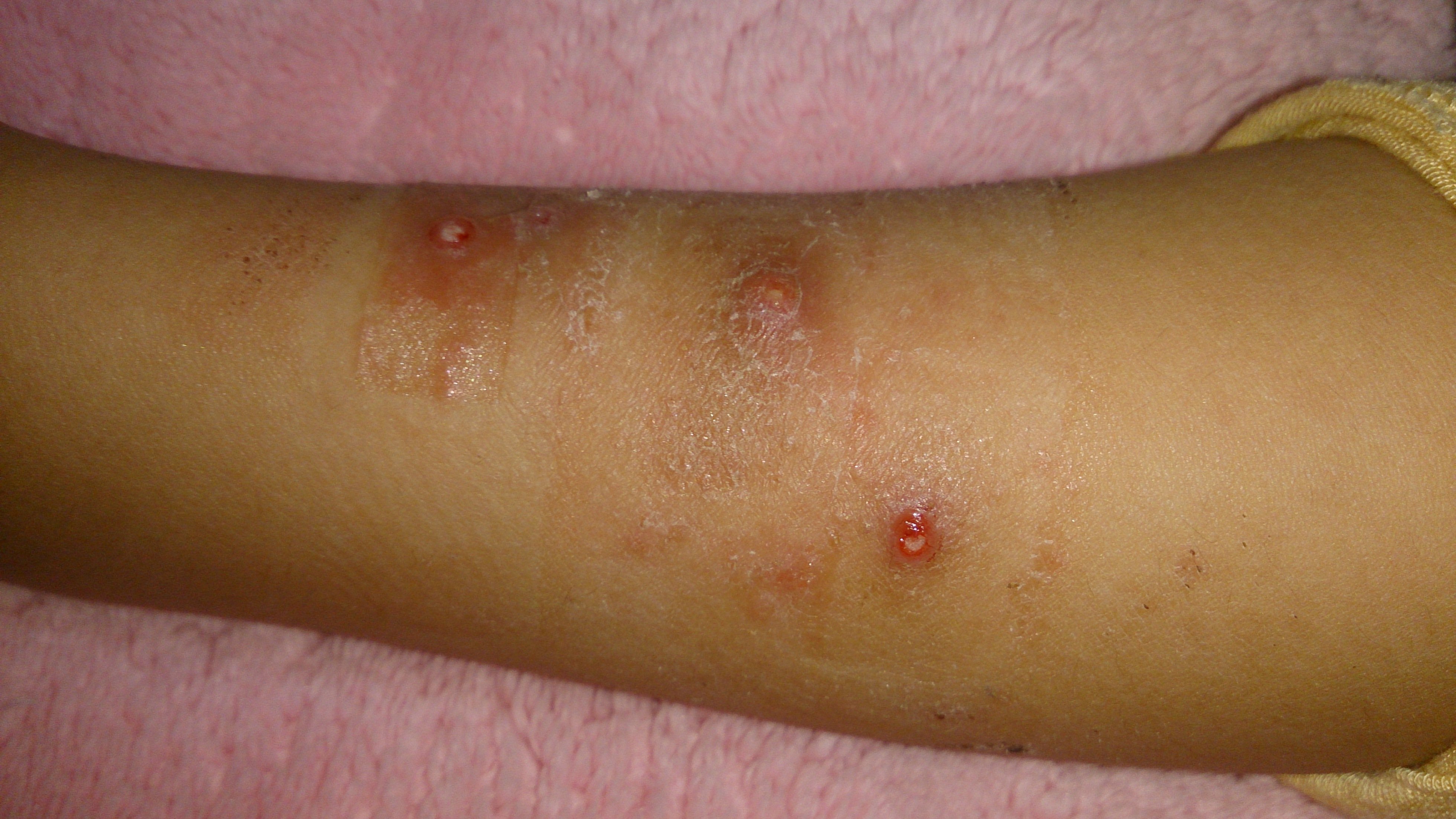 水いぼについてお願いします 過去質に画像を載せていますが 口内炎が沢山出来て小 Yahoo 知恵袋