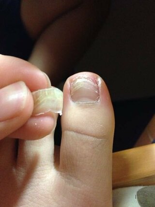 剥がれ 爪 た が 親指 の の 足 爪が剥がれたときの正しい処置方法！病院行く場合は何科なのかもご紹介！！