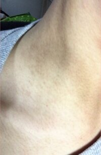 首の後ろの皮膚首の後ろがとても黒いです もともと色黒な方ですが Yahoo 知恵袋