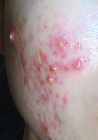 ニキビの盛り上がりを早くなくしたいのですがなにを頑張っててどのくらい Yahoo 知恵袋