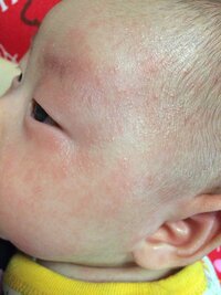 2ヶ月の赤ちゃんです 顔の湿疹がすごく目のまわりまで赤いんですが乳児湿疹でしょ Yahoo 知恵袋