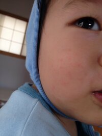 予防接種の副反応で 顔だけに湿疹て出ますか 1歳半です 22日の金曜 Yahoo 知恵袋