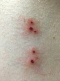 朝起きたらこのような虫刺され のような斑点みたいな跡が脇の下にあり何に刺された Yahoo 知恵袋