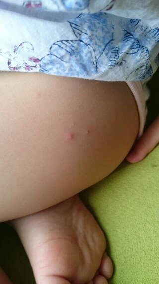 病 手足 水疱瘡 口