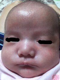 生後1ヶ月半の子の 乳児湿疹の病院へ行くタイミングで悩んでおります 1ヶ月 Yahoo 知恵袋