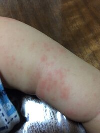 もうすぐ一歳の子供の湿疹についてです 二ヶ月前くらいから小児科 Yahoo 知恵袋