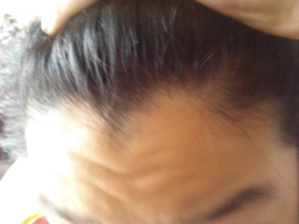 高校2年です中学の頃１度坊主にして気づいたんですが髪の毛がｍ字でした Yahoo 知恵袋
