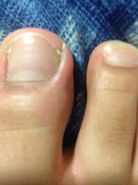 足の親指の爪の横の皮膚の部分が腫れていて痛いです 中学の頃から Yahoo 知恵袋