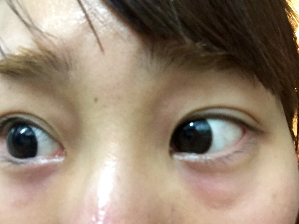 まだ20代前半なのに目のクマがひどいです 赤紫 っぽい色をしています 原因 改 Yahoo 知恵袋