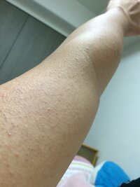 毛孔 性 苔 癬 ザラプロ 毛孔性苔癬の治療 二の腕のブツブツ ソララクリニック仙台 Amp Petmd Com