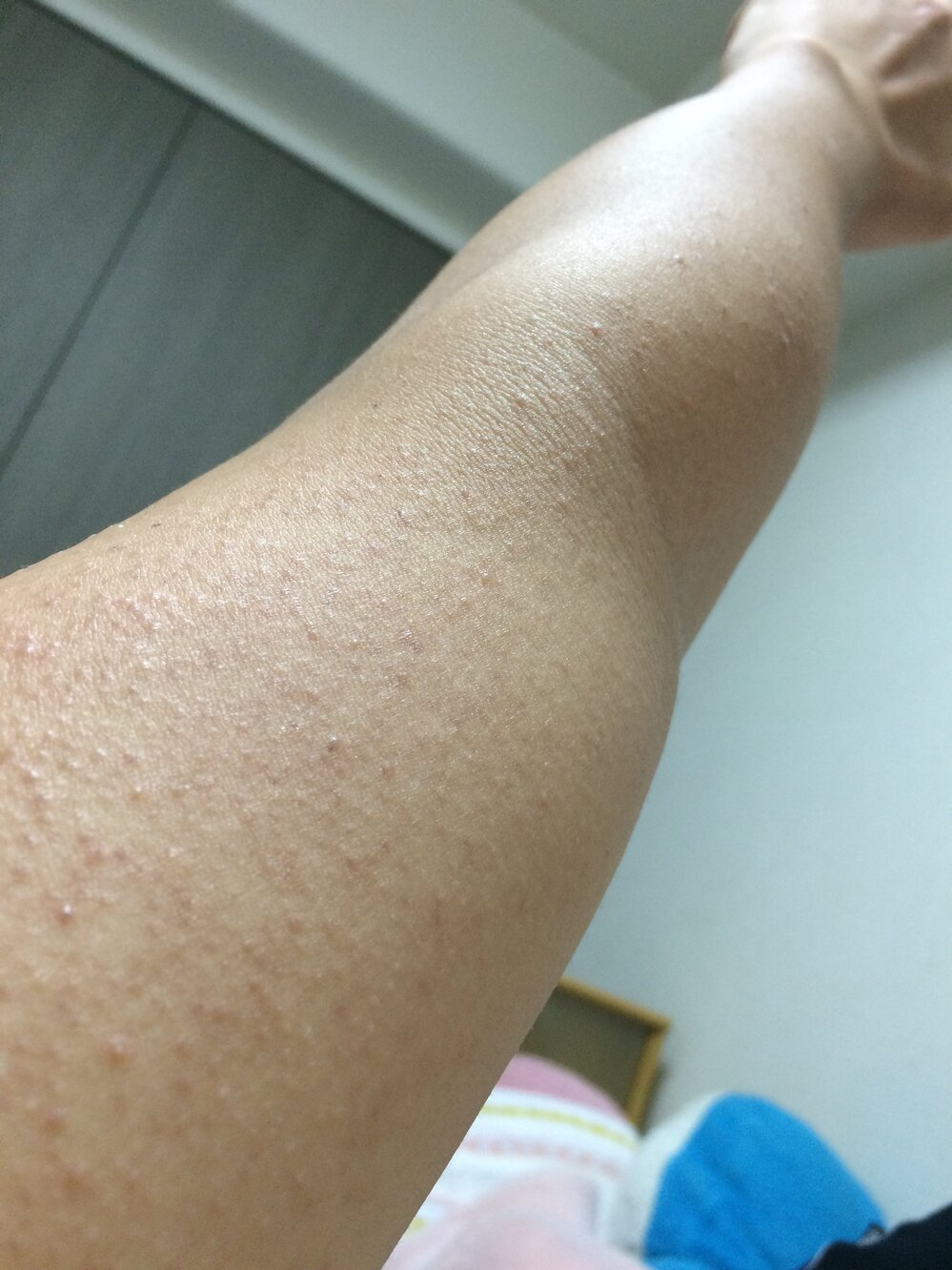 高2男子です僕は多分毛孔性苔癬だと思うんですがこれはどうしたら治るん Yahoo 知恵袋