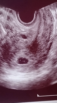 この胎嚢の中に卵黄嚢らしきものってみえますか エコー写真みるの Yahoo 知恵袋