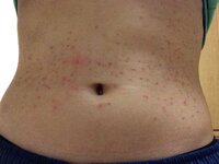 腹のニキビがヤバイです 同じ症状の人はいますか Yahoo 知恵袋