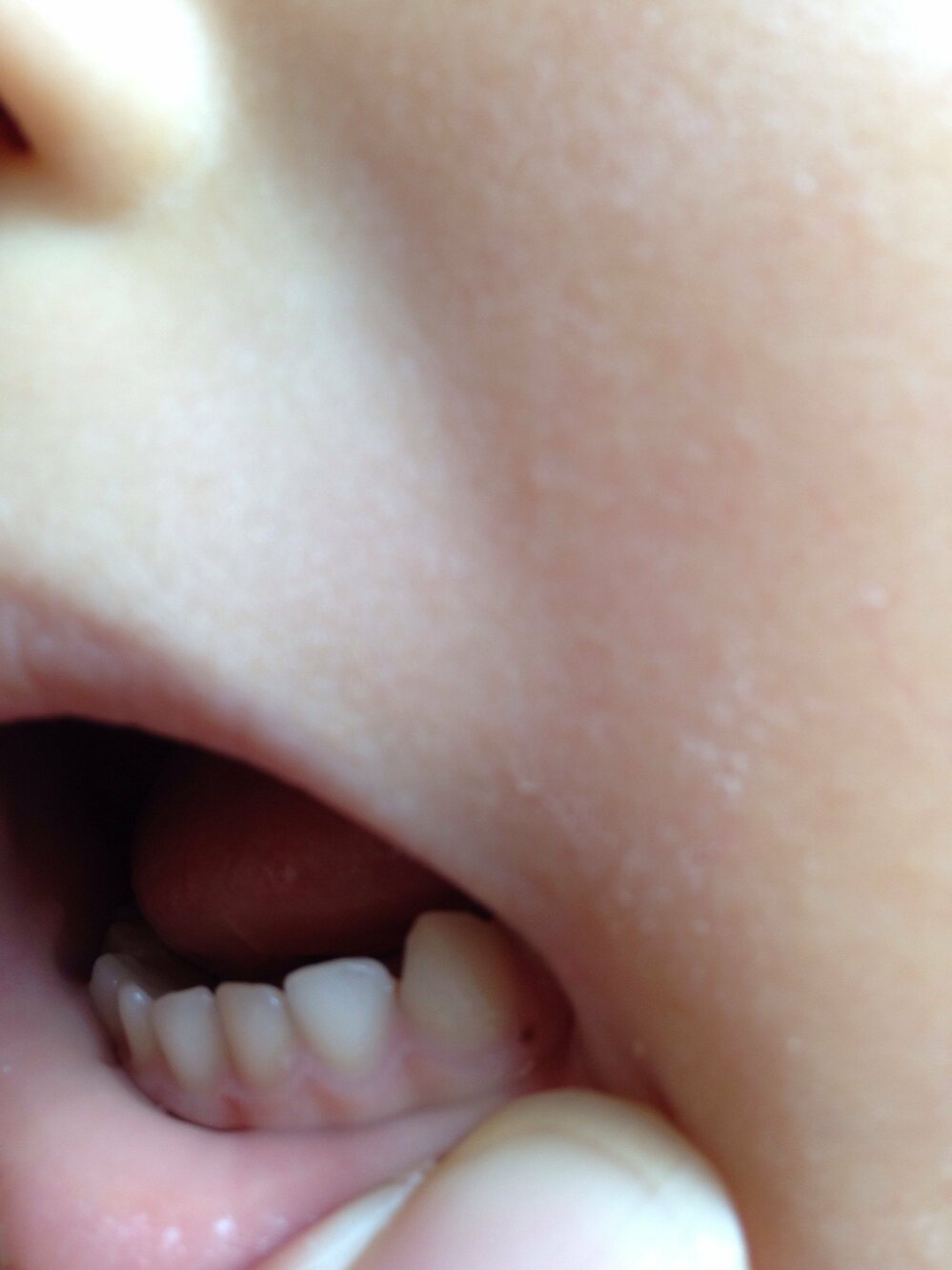 歯茎のシミ ホクロ について 3歳の子どもの下の前歯の歯茎にホクロ Yahoo 知恵袋