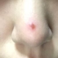 先週 鼻の頭にニキビができて潰してしまい 今日見てみると 触った時に空洞がある Yahoo 知恵袋