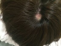 ストレスではない頭ニキビによる10円ハゲを隠したいです ヘアスプレーなどで頭ニ Yahoo 知恵袋