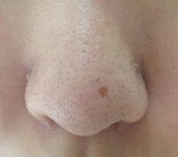 鼻の角栓 黒ずみ 脂が酷いです 治したいです 代の女性です 小学生高学年の Yahoo 知恵袋