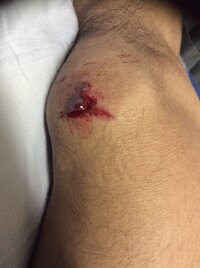 緊急で困っています 自転車で倒れて膝の肉が5ミリくらいえぐれてしまいました 周 Yahoo 知恵袋