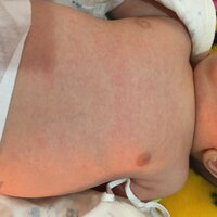 赤ちゃんのお腹の小さく赤い湿疹について教えて下さい これは乳児性湿疹 Yahoo 知恵袋