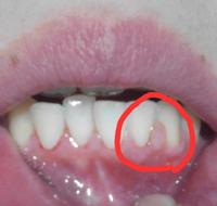 下の前歯と前歯の間の歯肉がとれそうです 普通 歯と歯の間の歯肉は歯にくっついて Yahoo 知恵袋