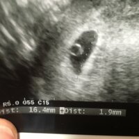 胎嚢胎芽について２つ気になることがあります 念願の赤ちゃんを授かるこ Yahoo 知恵袋