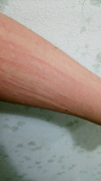 赤色皮膚描記症 に関するq A Yahoo 知恵袋