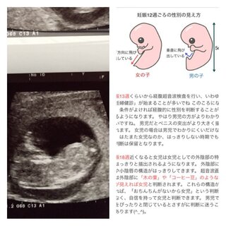 ダウンロード済み 赤ちゃん エコー 性別 12週 あなたのための赤ちゃんの画像