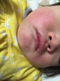 1歳の娘の頬の赤みについて 先週から風邪気味で鼻水 痰 咳が出ます 熱は Yahoo 知恵袋