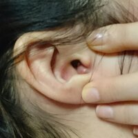 半月ほど前から耳にできものができてこまっています水ぶくれのようにぷに Yahoo 知恵袋