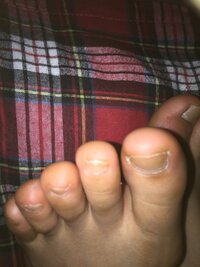 指先が左右ともに晴れて痛いですこれって 何科でしょうか 痛風でしょうか それと Yahoo 知恵袋