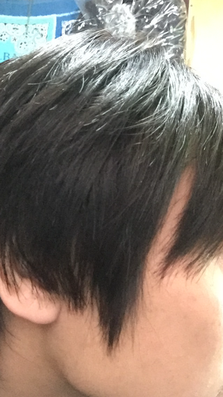 最近 この画像のように横から見ると隙間ハゲみたいなものができます かなり悩んで Yahoo 知恵袋