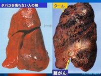 sokonoke2008さんの発言、
、
１、『だいたいが、依存性治療と依存症治療とで何がどう違ってくるのさ。
どこが内容違いなのさ。 依存性治療も依存症治療も どちらも内容は一緒じゃねぇか、バ～カ。
』

２、『↑なにを影でゴチャゴチャ言い訳してるんですか？、おバカさんや。
【週刊東洋経済】でのタバコ特集には【依存性治療】と書かれているから【依存性治療】と私は転記しているので...