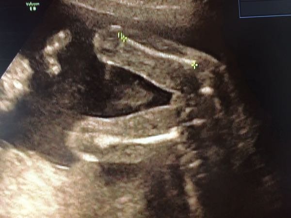 20週のエコー写真の性別 病院が性別を教えてくれない方針なのですが Yahoo 知恵袋