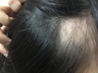 右側のこめかみが円形脱毛症になってしまいました ストレスによる Yahoo Beauty