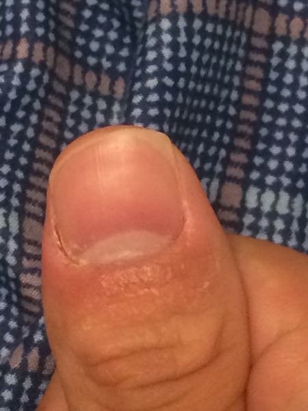 爪の甘皮についてなのですが 写真の通り甘皮がなくなってしまっています写真に Yahoo 知恵袋