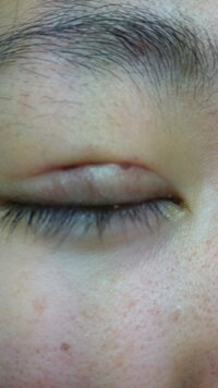 埋没法をして一週間がたちました赤い部分の所は埋没の糸なんですが 表面から見える Yahoo 知恵袋