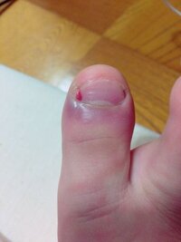 ささくれがを剥いたら 肉ごと剥けて放って置いたらこうなりました Yahoo 知恵袋